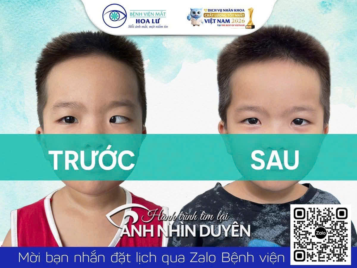 PHẪU THUẬT MẮT LÁC THÀNH CÔNG CHO BÉ TRAI 5 TUỔI